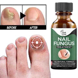 Nail Fungal Treatments